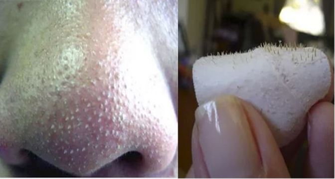 How To Get Rid Of Blackheads On Nose Fast At Home