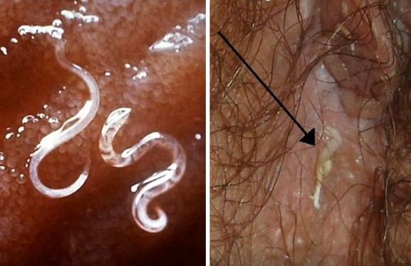 How to Tell If You Have Parasites or Yeast and How to Get Rid of Them Naturally